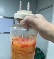南京水动力吸脂手术要做多久？